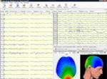 фото ЭЭГ Нейрон-Спектр электроэнцефалограф для профосмотров